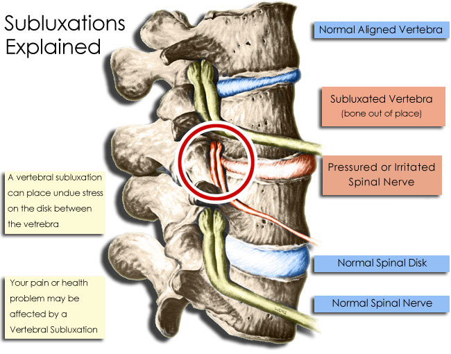 Subluxations Explained