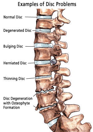 Example of Spine Problems